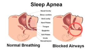 apnea