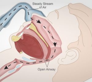 Sleep Apnea Techniques