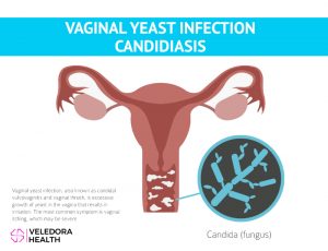 yeast infection