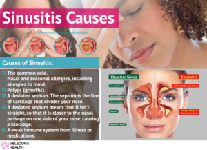 sinusitis