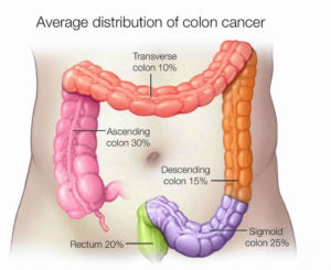 COLON CANCER