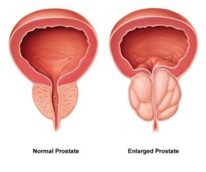 prostate cancer