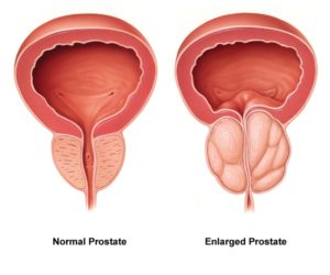 prostate cancer