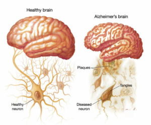 Alzheimer’s Disease!