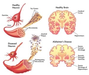 Alzheimer’s Disease!
