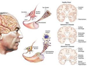 Alzheimer’s Disease!