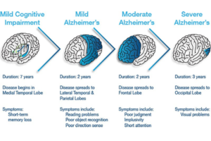 Alzheimer’s Disease!