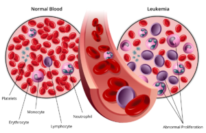 child leukemia