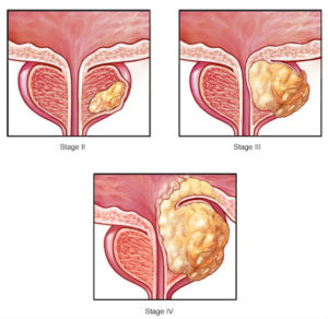 prostate cancer