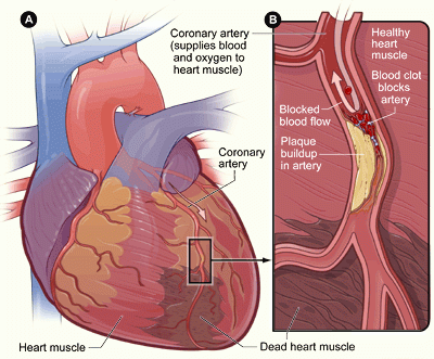 chd