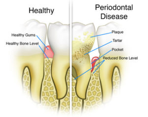 gum disease