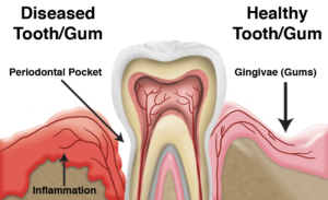 gum disease