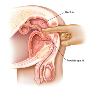 prostate cancer