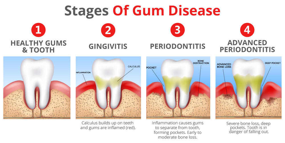 gum disease