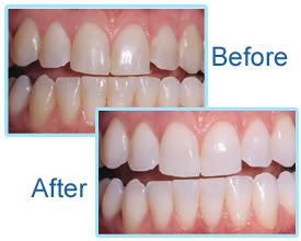 teeth whitening