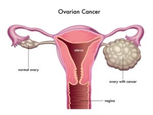 ovarian cancer overview