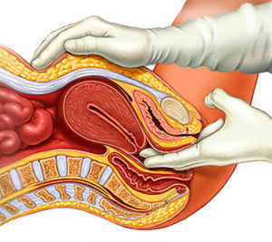 ovarian cancer overview