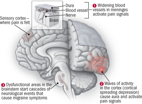 migraines