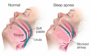 Sleep Apnea Techniques