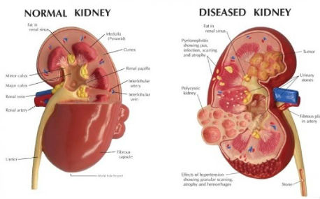 prevent kidney