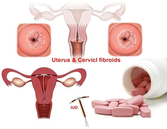 Menorrhagia