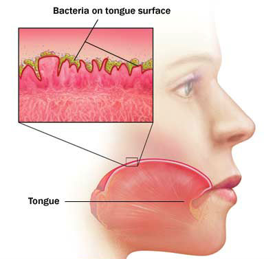 halitosis