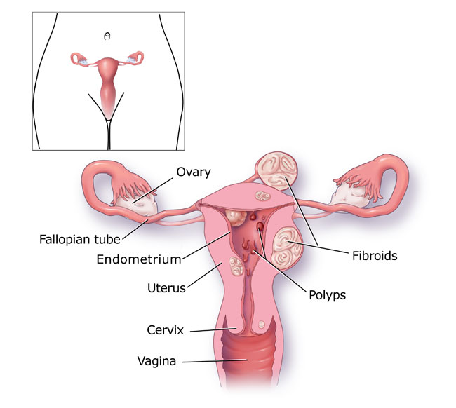 Menorrhagia