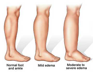 Fluid Retention