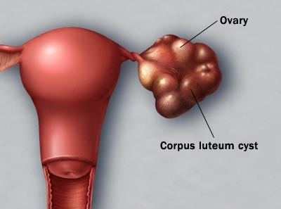 ovarian cysts