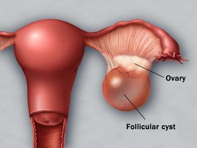 ovarian cysts