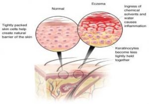 eczema