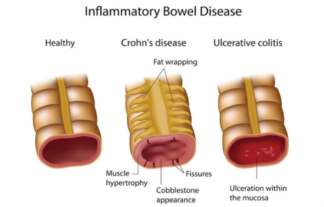 IBD