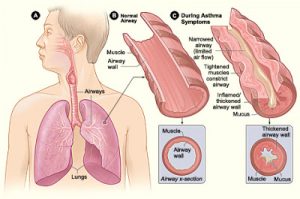 asthma diet