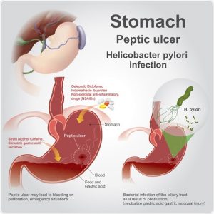 Pectic ulcer