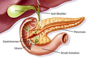 peptic ulcer