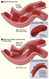 sickle cells