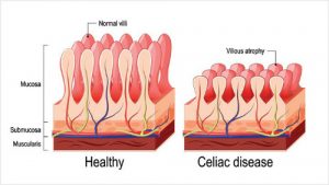 CELIAC