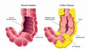 Crohn's disease 
