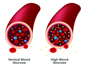 low blood glucose