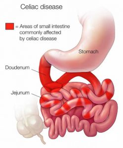 CELIAC