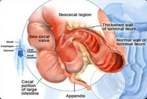 crohn's disease