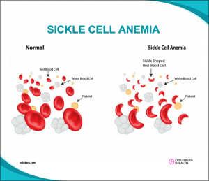 sickle cell