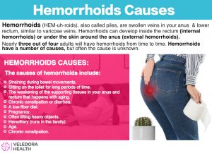 HEMORRHOIDS