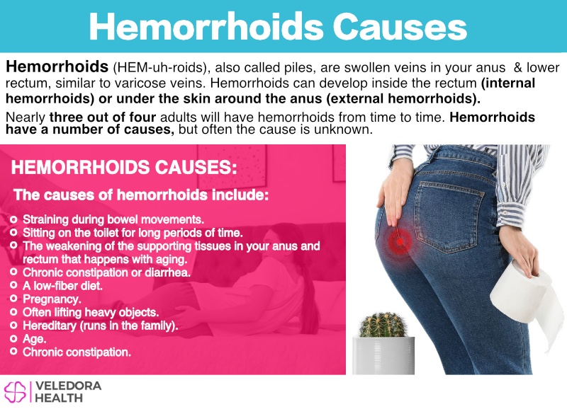 Hemorrhoids Causes Symptoms And Treatment
