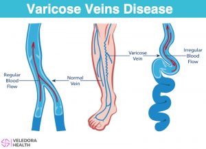 varicose veins