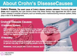 Crohn's disease