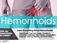 hemorrhoids