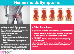 hemorrhoids