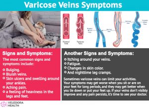 varicose veins