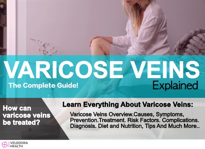 Varicose Veins